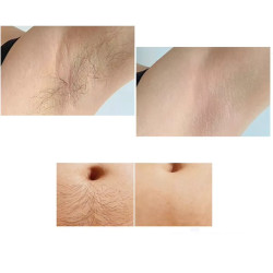 Epiliacijos diodo lazeris 808 nm plaukų šalinimui