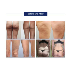 Vakuumins aparatas kūno liekninimui