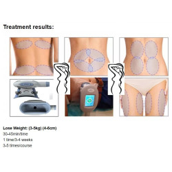 Krioterapijos kriolipolizės aparatas