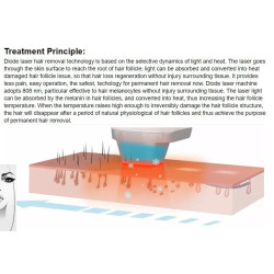 Epiliacijos diodo lazeris IPL 4