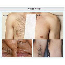 Epiliacijos diodo lazeris IPL 4