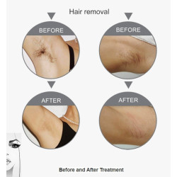 Epiliacijos diodo lazeris IPL 4