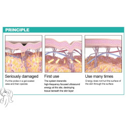 HIFU Veido kūno liekninimo formavimo aparatas