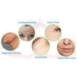 HIFU Veido formavimo aparatas