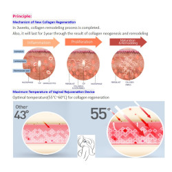 HIFU Makšties stangrinimo. Veido formavimo aparatas