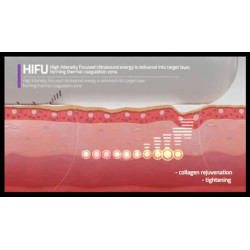 HIFU Makšties stangrinimo. Veido formavimo aparatas