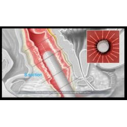 HIFU Makšties stangrinimo. Veido formavimo aparatas