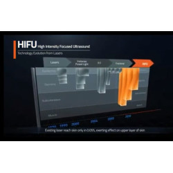 HIFU Makšties stangrinimo. Veido formavimo aparatas