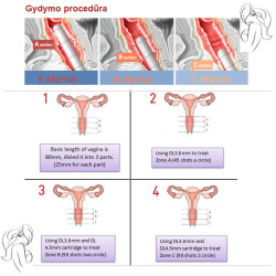 HIFU makšties stangrinimo aparatas