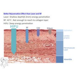HIFU makšties stangrinimo aparatas