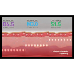 HIFU makšties stangrinimo aparatas