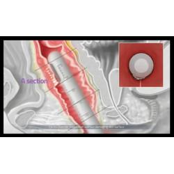 HIFU makšties stangrinimo aparatas