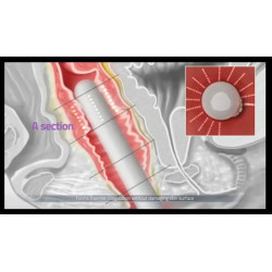 HIFU makšties stangrinimo aparatas