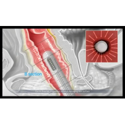 HIFU makšties stangrinimo aparatas