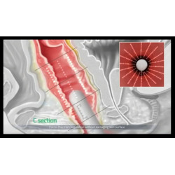 HIFU makšties stangrinimo aparatas