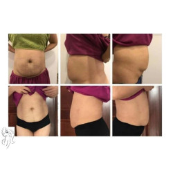 HIFU liposakcinis kūno liekninimo aparats