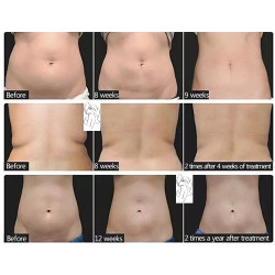 HIFU liposakcinis kūno liekninimo aparats