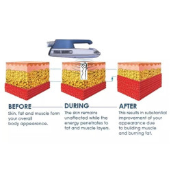 Riebalų pašalinimas ir kūno linijų formavimas