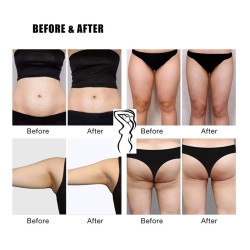 Riebalų pašalinimas ir kūno linijų formavimas