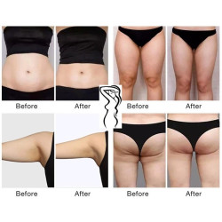 Riebalų pašalinimas ir kūno linijų formavimas