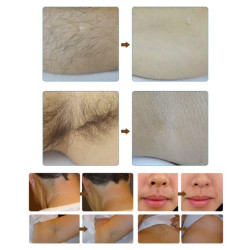 Epiliacijos diodo lazeris 808 nm