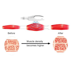 Riebalų pašalinimas ir kūno linijų formavimas