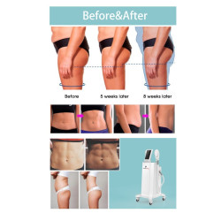 Riebalų pašalinimas ir kūno linijų formavimas