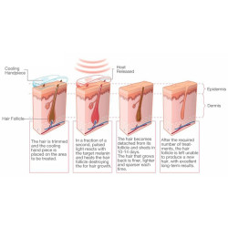 Epiliacijos diodo lazeris 808 nm