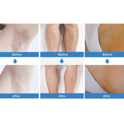 Epiliacijos diodo lazeris 808 nm