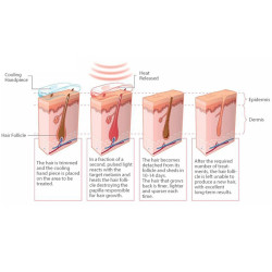 Epiliacijos diodo lazeris 808 nm PLIUS