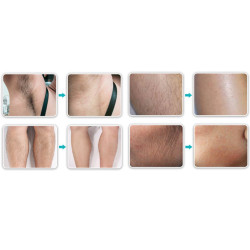 Epiliacijos diodo lazeris 808 nm