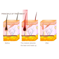 Epiliacijos diodo lazeris 808 nm