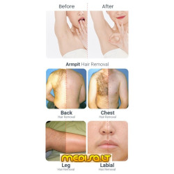 Epiliacijos diodo lazeris 808 nm home