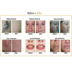 IPL ND YAG lazeris 2in1