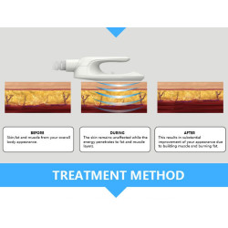 Riebalų pašalinimas ir kūno linijų formavimas