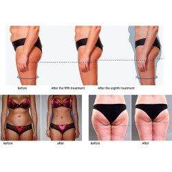 Riebalų pašalinimas ir kūno linijų formavimas