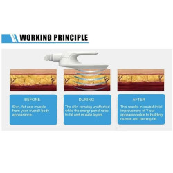 Riebalų pašalinimas ir kūno linijų formavimas