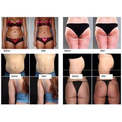 Riebalų pašalinimas ir kūno linijų formavimas