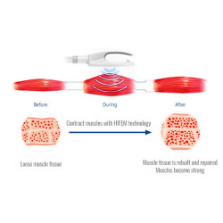 Riebalų pašalinimas ir kūno linijų formavimas