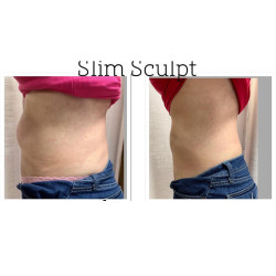 Riebalų pašalinimas ir kūno linijų formavimas