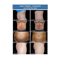 Riebalų pašalinimas ir kūno linijų formavimas