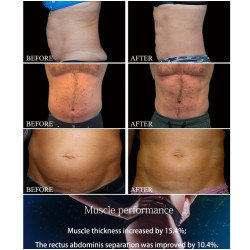 Riebalų pašalinimas ir kūno linijų formavimas