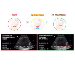 Riebalų pašalinimas ir kūno linijų formavimas