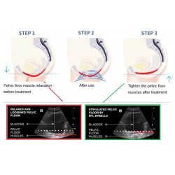 Riebalų pašalinimas ir kūno linijų formavimas