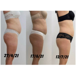 Riebalų pašalinimas ir kūno linijų formavimas