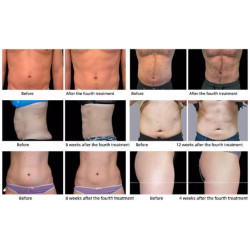 Riebalų pašalinimas ir kūno linijų formavimas