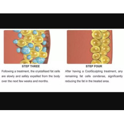 Krioterapijos kriolipolizės RF Lipo Lazerio aparatas