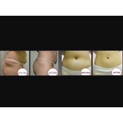 Krioterapijos kriolipolizės RF Lipo Lazerio aparatas