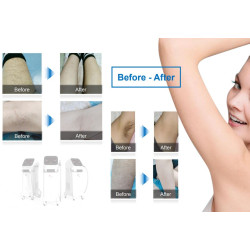 Epiliacijos diodo lazeris 808 nm