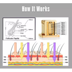 Epiliacijos diodo lazeris 808 nm